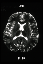 MRI Scan of 28-Year-Old Chronic Solvent Abuser